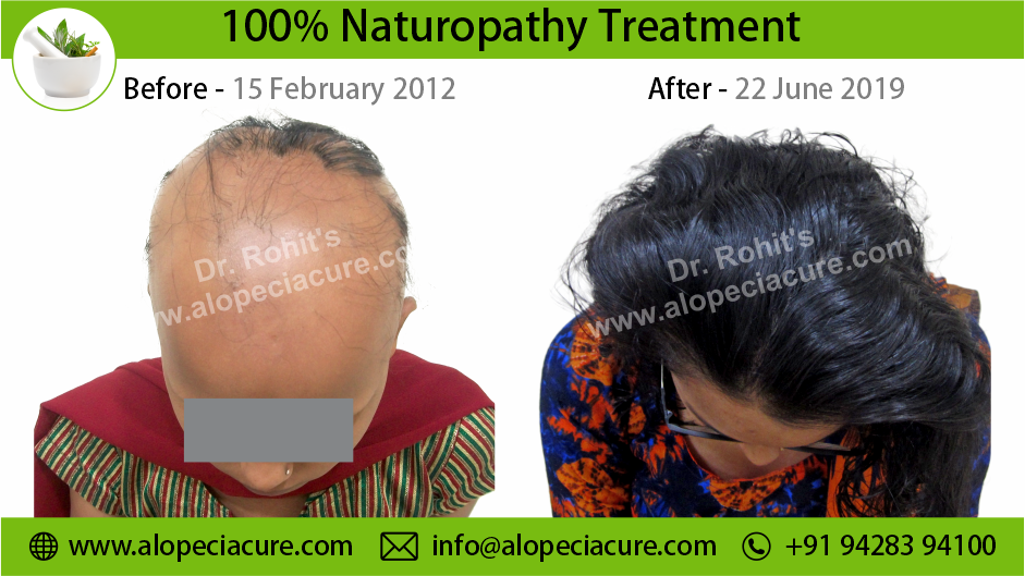 Alopecia Areata Result 4